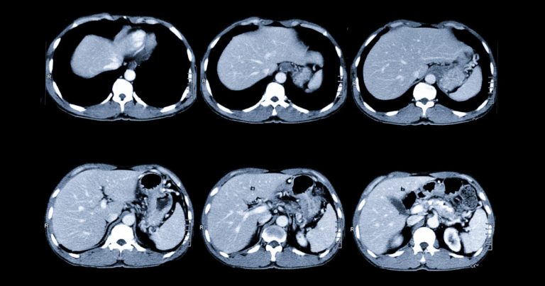 кт черевної порожнини