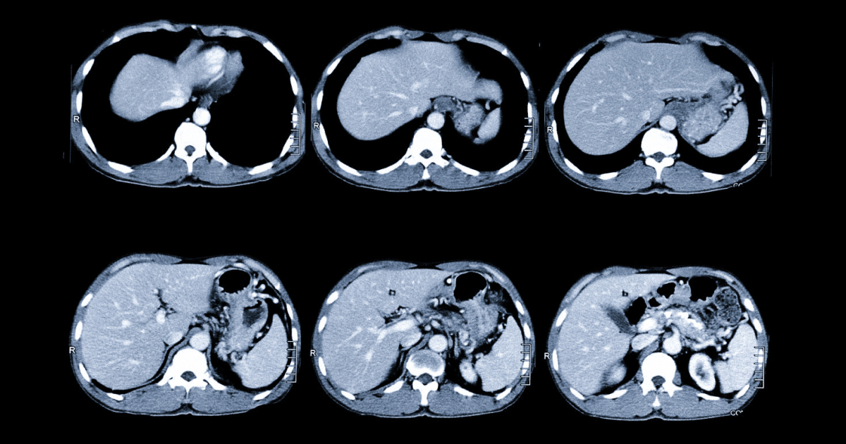 кт черевної порожнини
