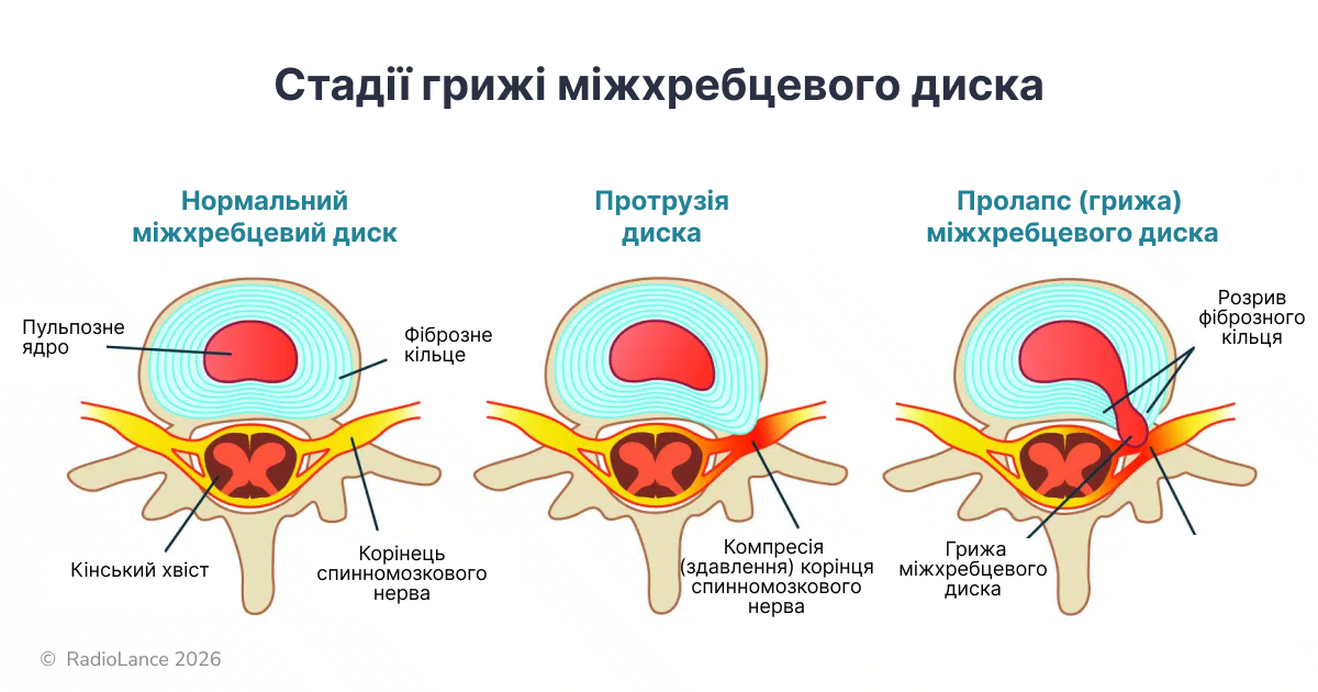 Стадії грижі міжхребцевого диска