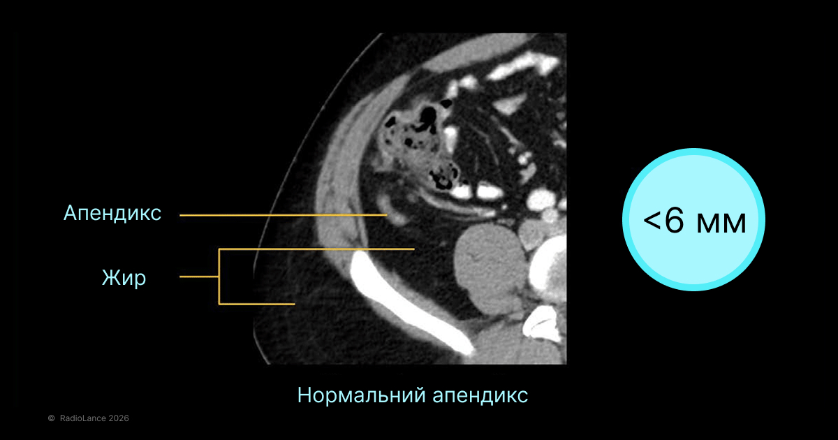 нормальний апендикс