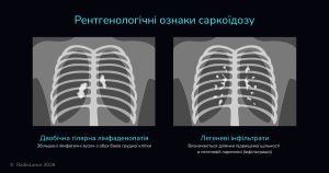 Рентгенологічні ознаки саркоїдозу