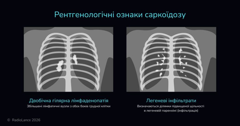 Рентгенологічні ознаки саркоїдозу