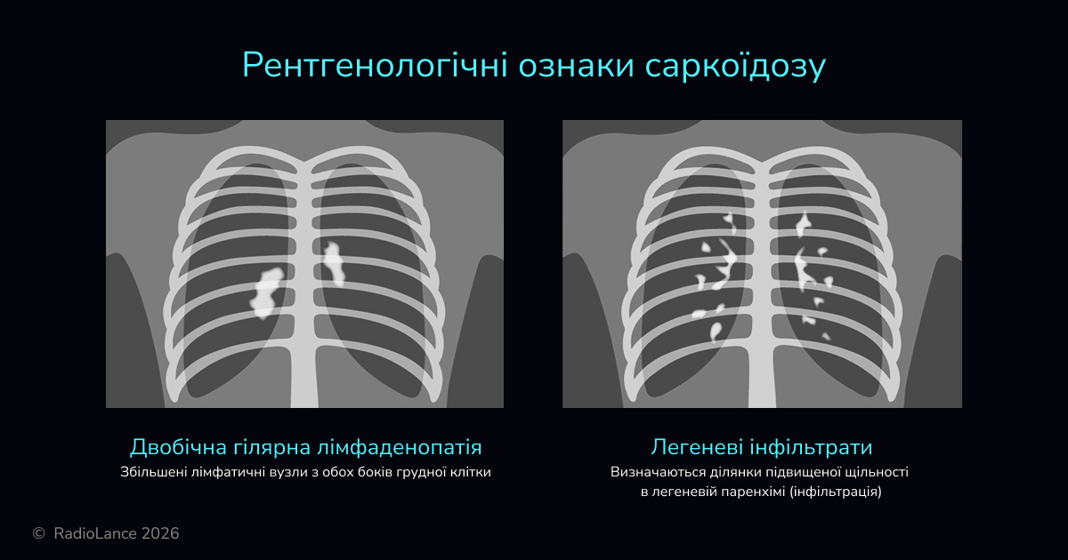Рентгенологічні ознаки саркоїдозу