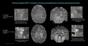 мрт діагностика розсіяного склерозу