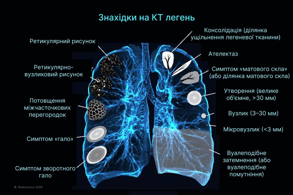 Поширені знахідки на КТ легень