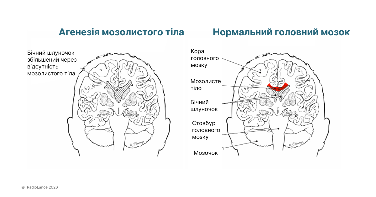 Дисгенезія мозолистого тіла