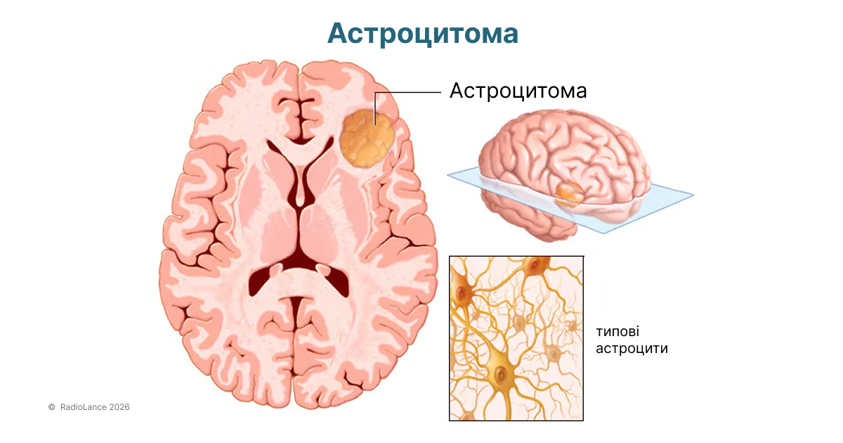 Астроцитома