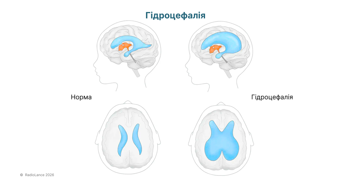 Гідроцефалія головного мозку