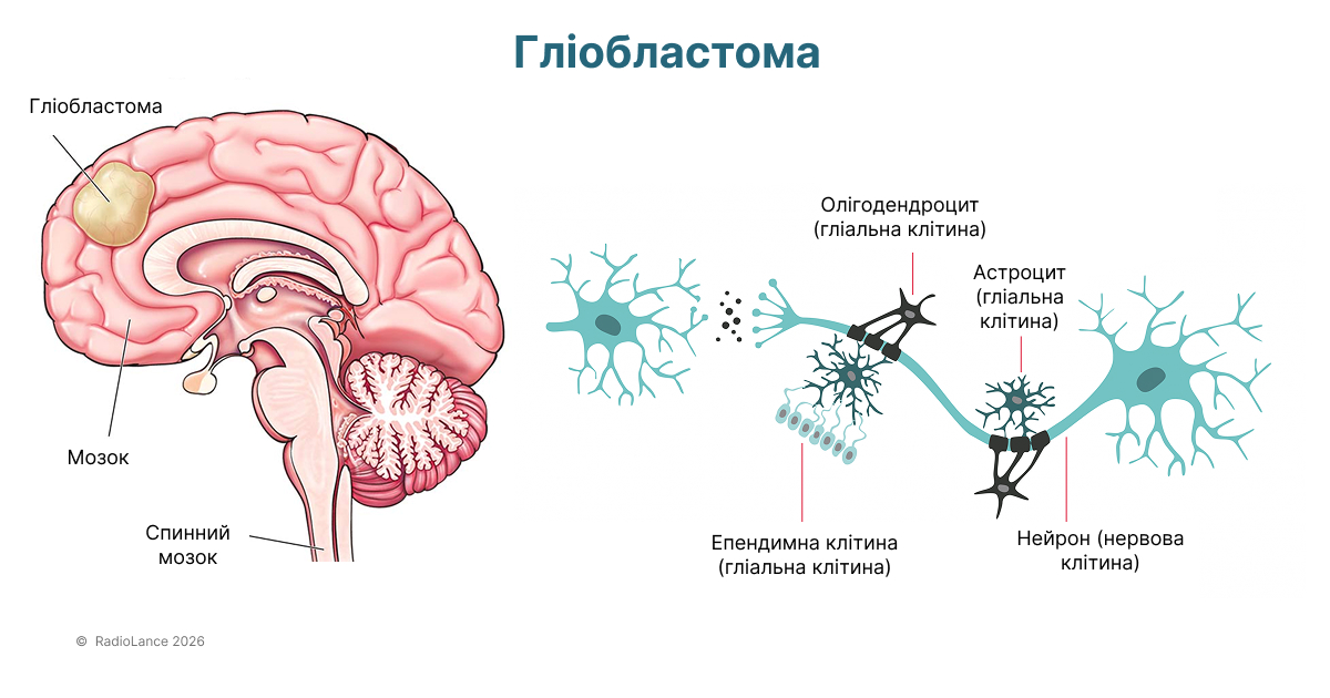 Гліобластома