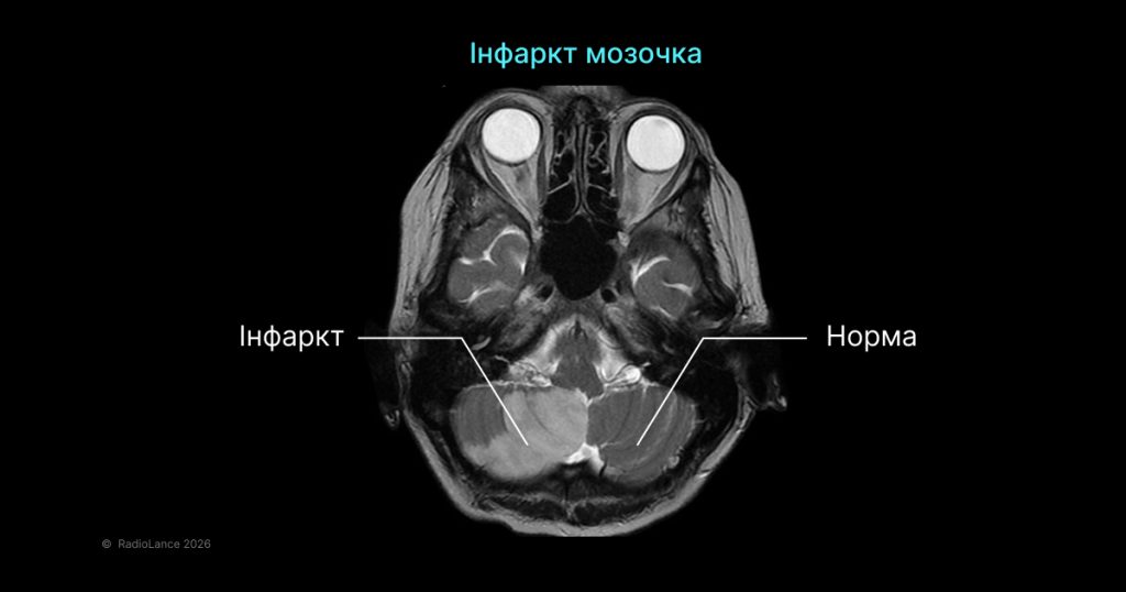 Інфаркт мозочка