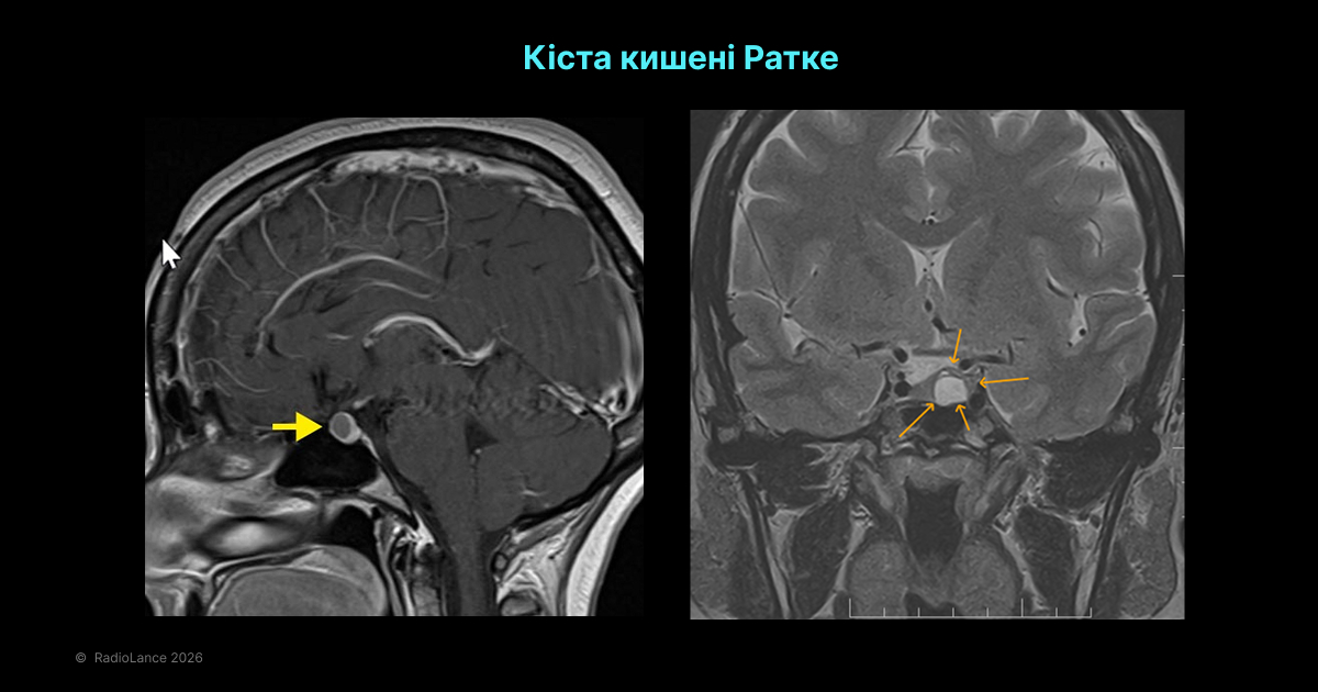 Кіста кишені Ратке