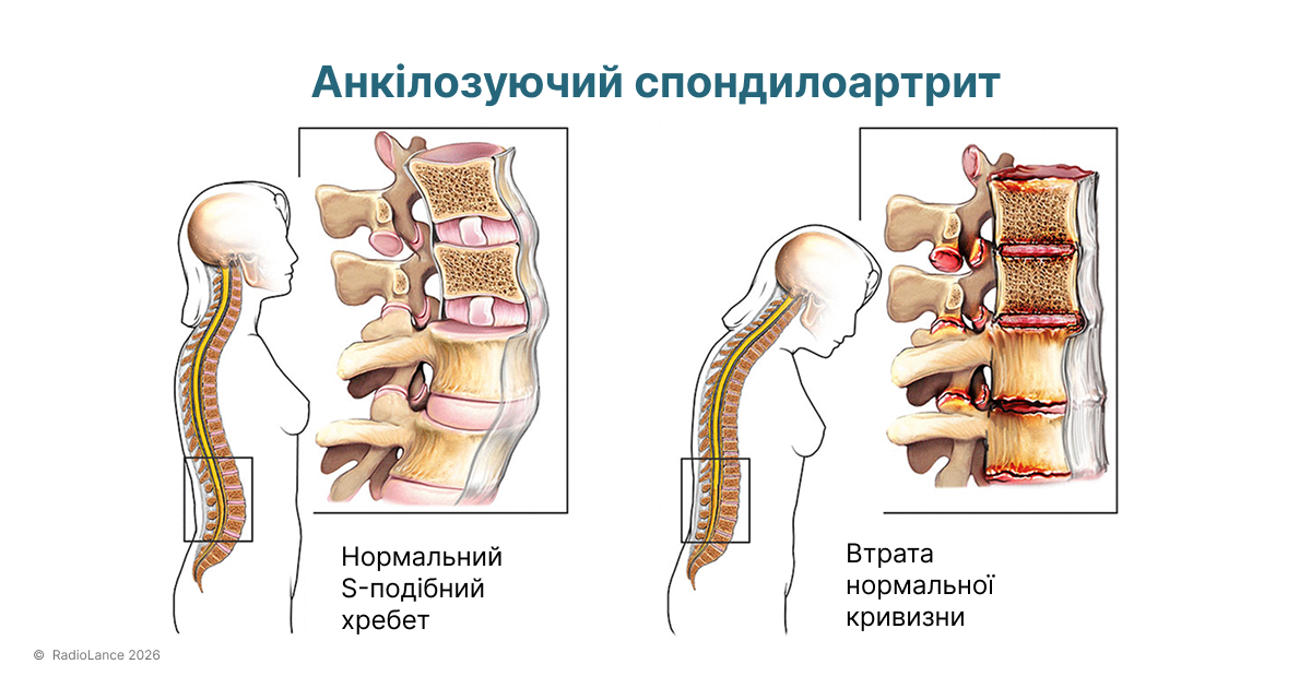 Анкілозуючий спондилоартрит як виглядає