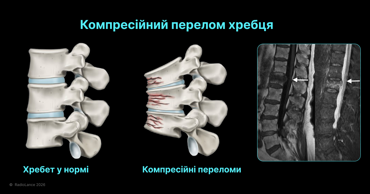 Компресійний перелом хребця