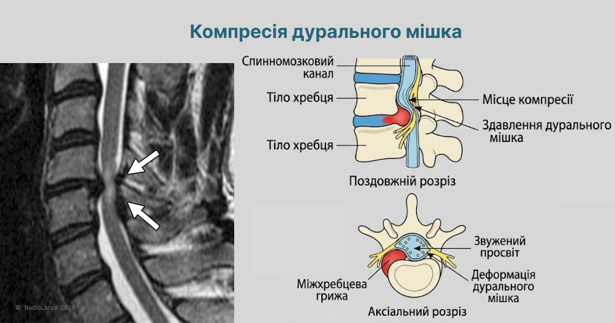 Компресія дурального мішка