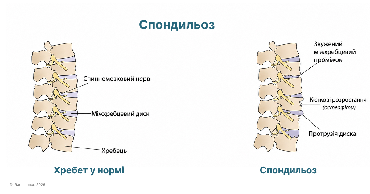 як виглядає спондильоз